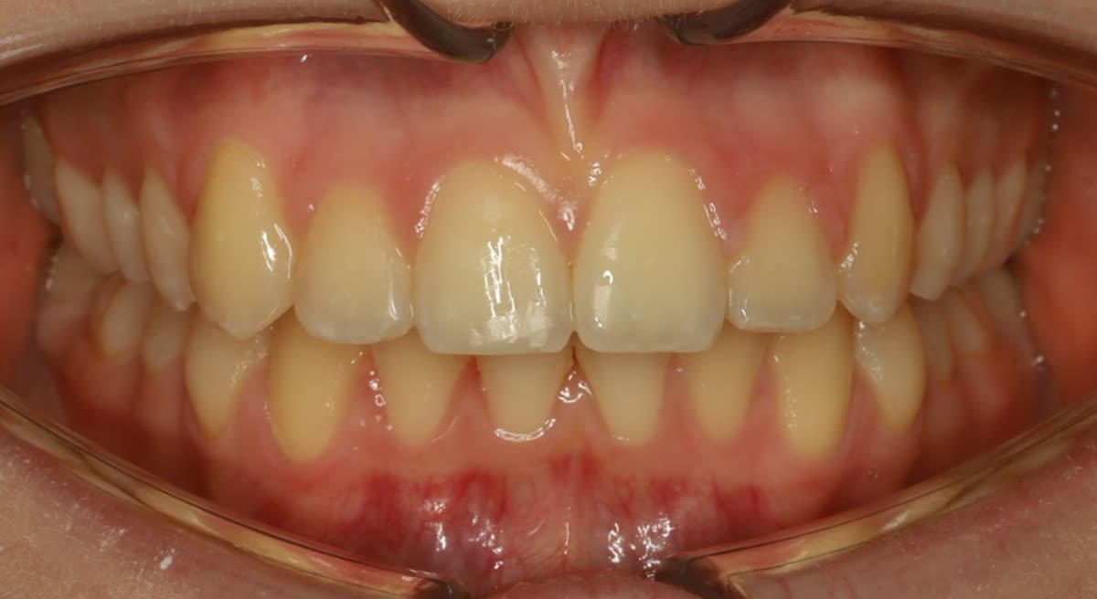 Clinical case #2. Clinical result