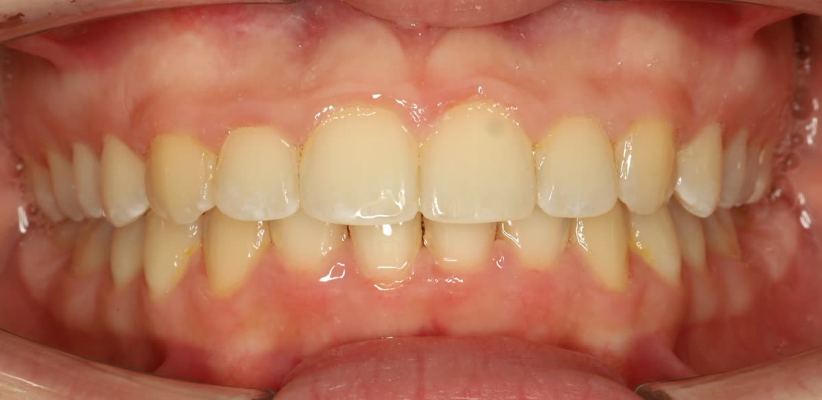 Clinical case #1. Clinical result