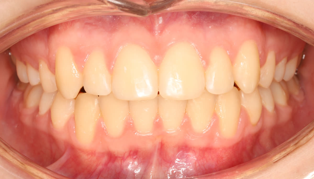 Clinical case #3. Clinical result